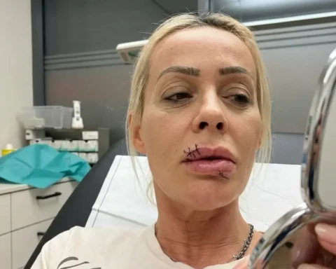 cora-schumacher-notaufnahme-lippenverletzung